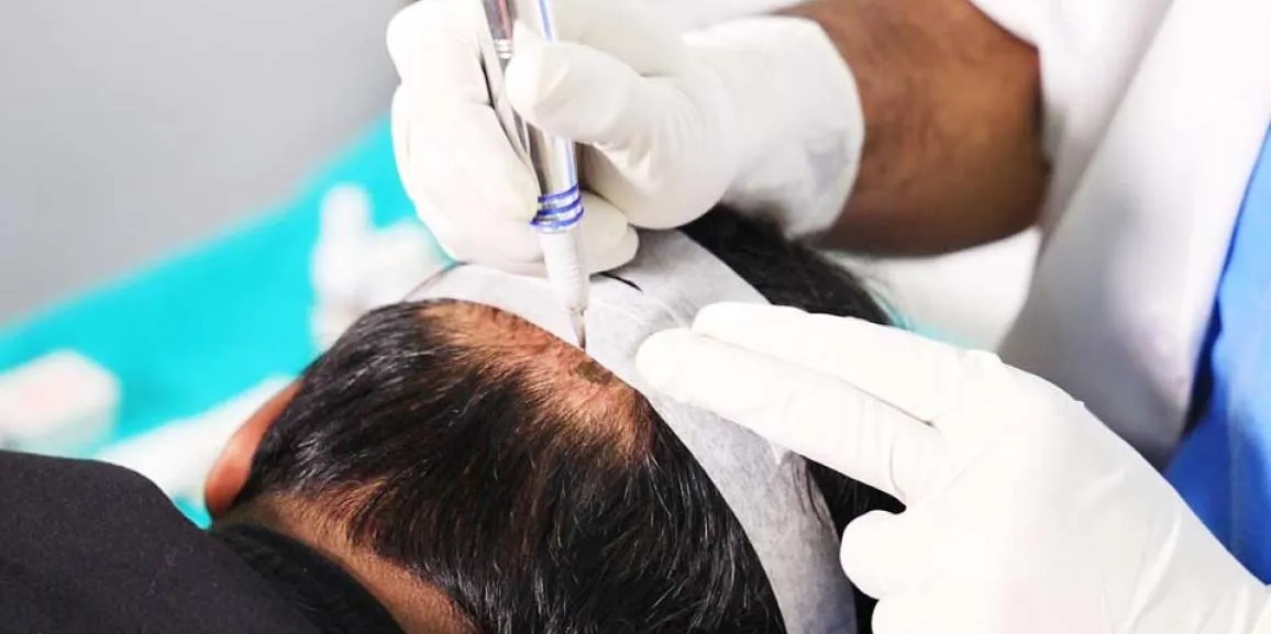 Hair Transplant Istanbul: Your Roadmap to Natural Hair Regrowth