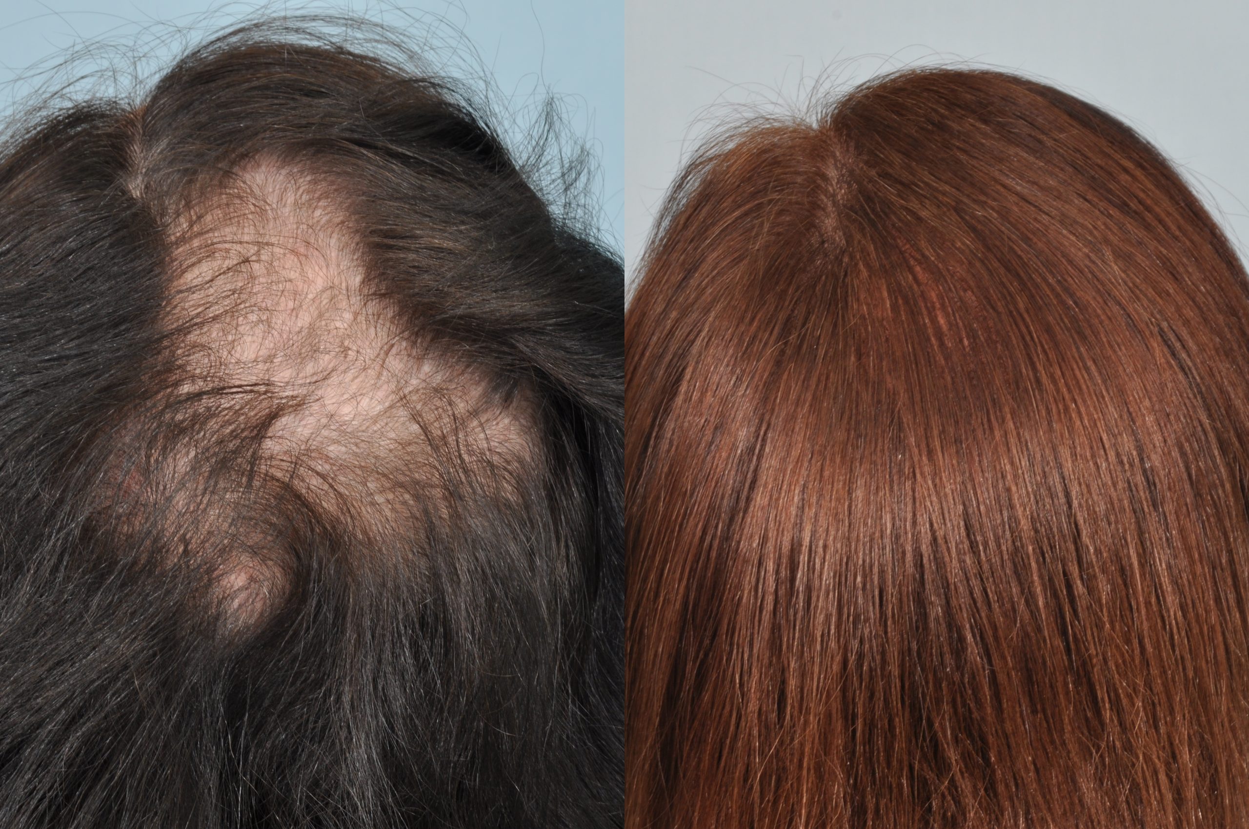 Hair Transplant London: How We Achieve Natural, Undetectable Results